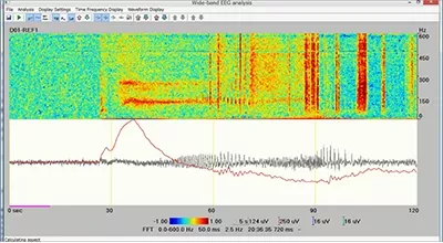 Image solution neuromonitoring 10